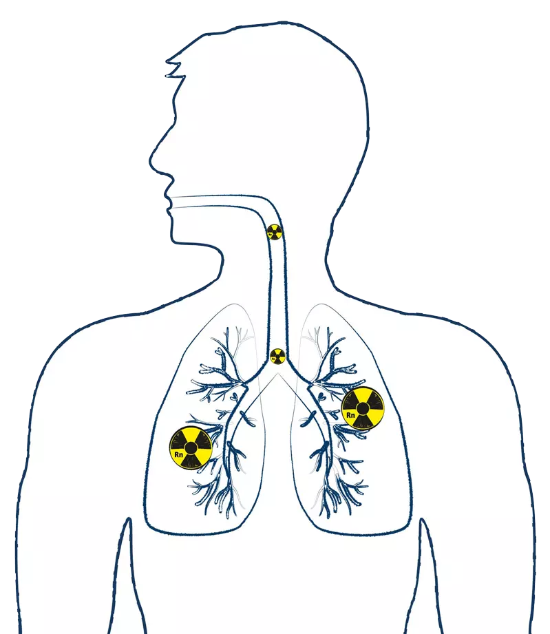 Eine Lunge in der Radongas zu erkennen ist.
